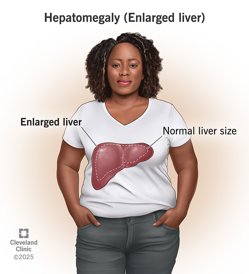 Normal liver compared to a liver with hepatomegaly (enlarged liver)