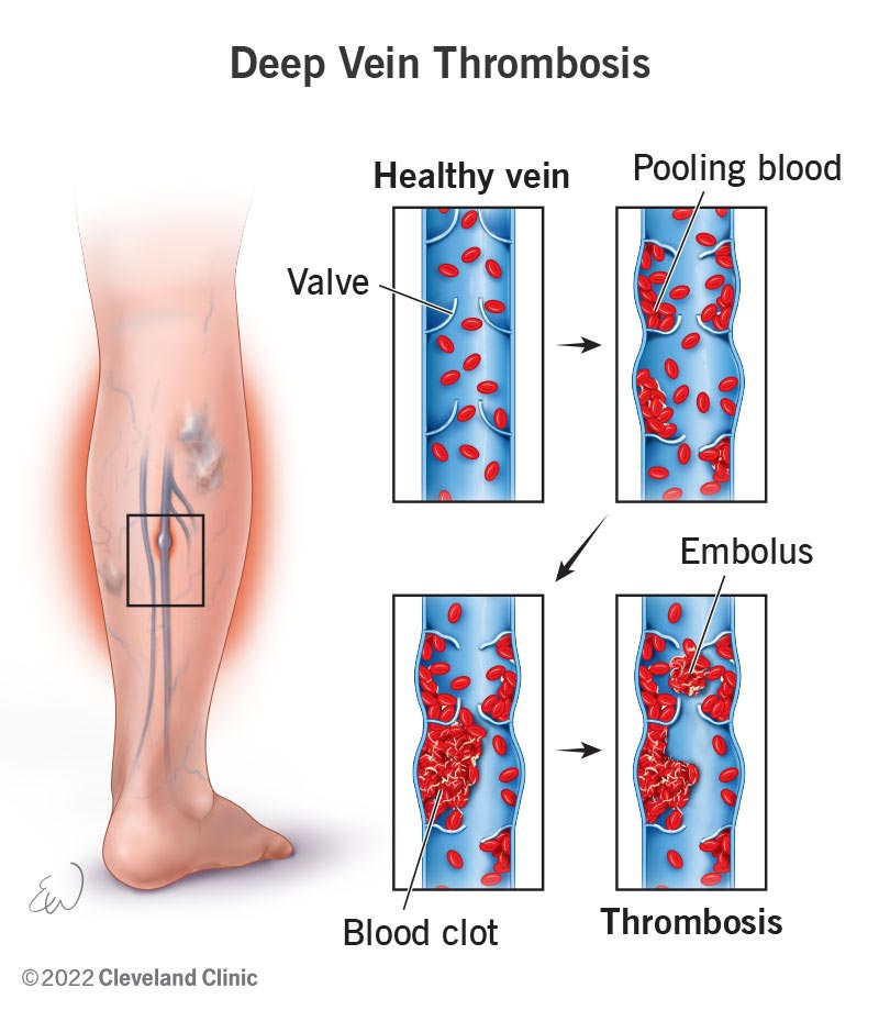 The process of deep vein thrombosis (DVT) occurring inside a leg vein.