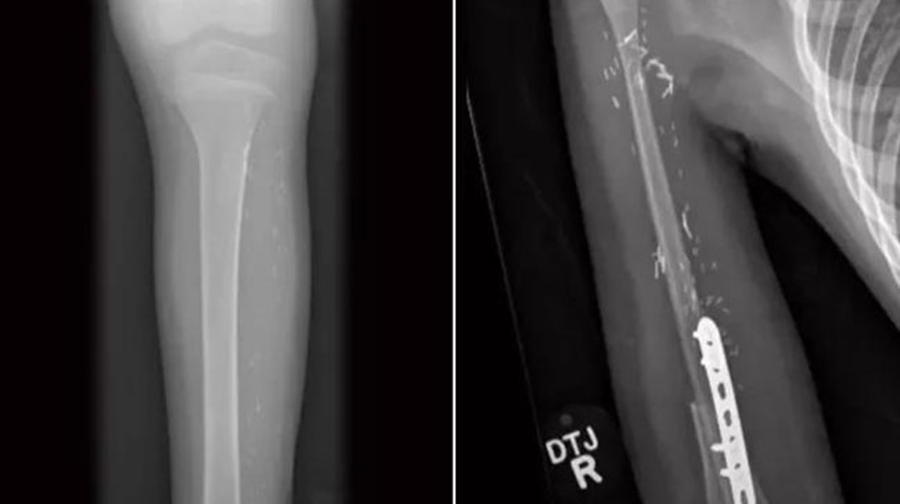 A scan of Myles' leg and arm before and after his surgery.