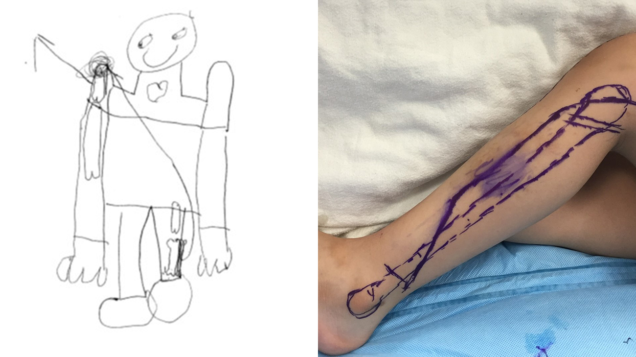 Myles sketched a drawing for Dr. Mesko after his diagnosis (left). Presurgery planning on Myles' leg (right).